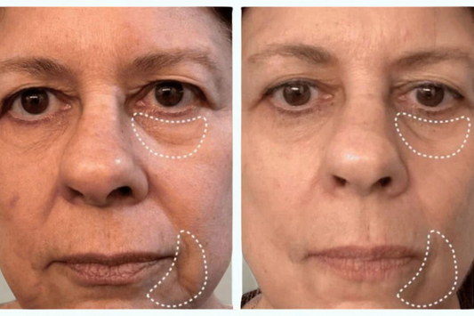 Reducción de las ojeras