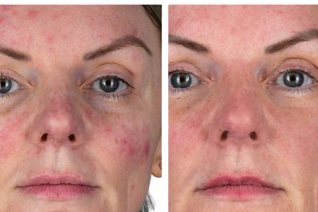 Cuidado del eczema