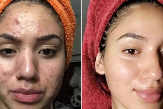 Anti imperfecciones